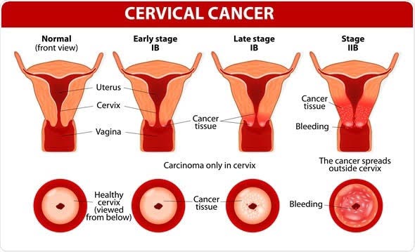 Cervical Cancer; A Preventable Disease oou